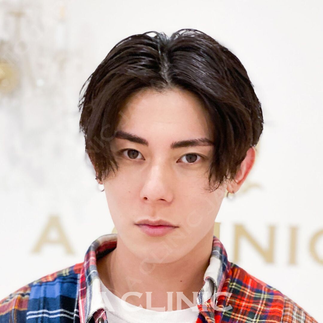 即日スッキリ周りから憧れられる小顔に大変身！Aスレッドの処置前と処置直後の症例です(30代男性) AFTER