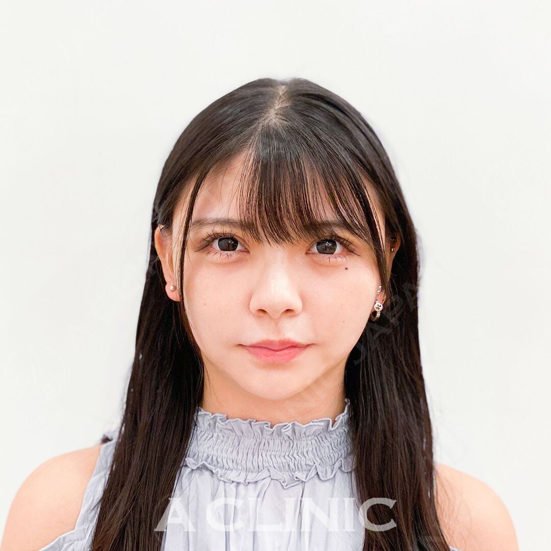 周りから憧れられるような綺麗なVフェイスに大変身！Aスレッドの処置前と処置直後の症例です(20代女性) AFTER