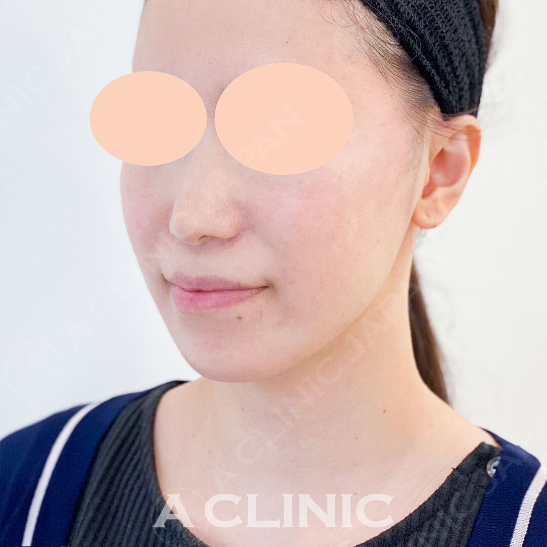 口横のもたつきもその日のうちに解消！Aスレッドの処置前と処置直後の症例です(30代女性) AFTER