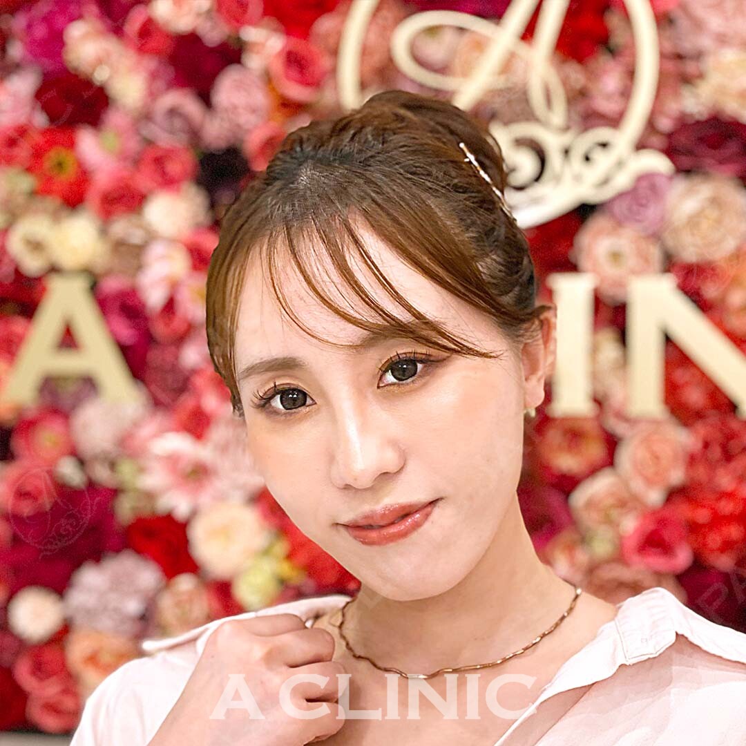 Aスレッドならダウンタイムなしで綺麗なフェイスラインに！施術前と施術直後の症例です(30代女性) AFTER