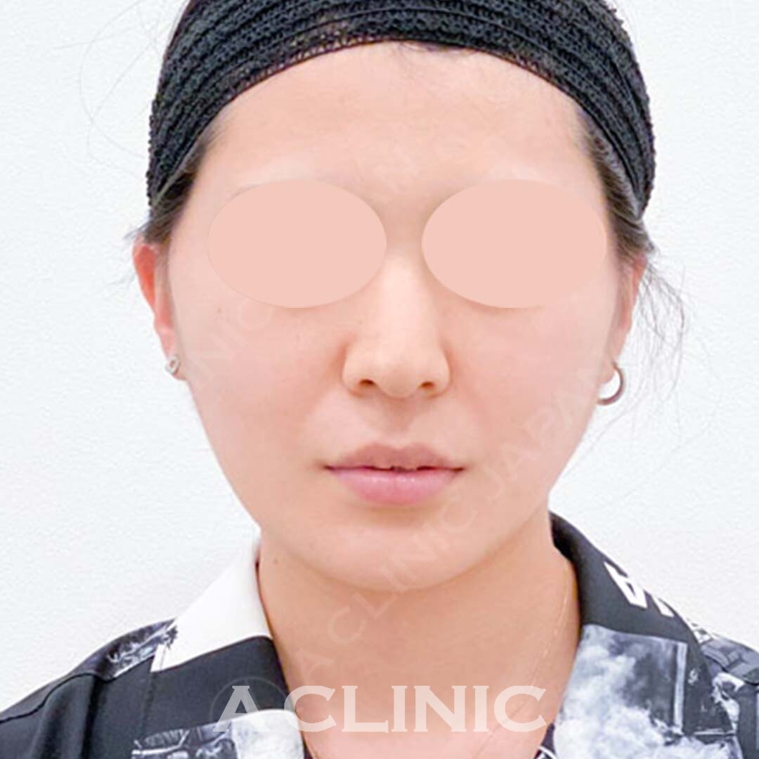 将来のたるみ予防に効果的です！Aスレッドの処置前と処置直後の症例です(20代女性) AFTER