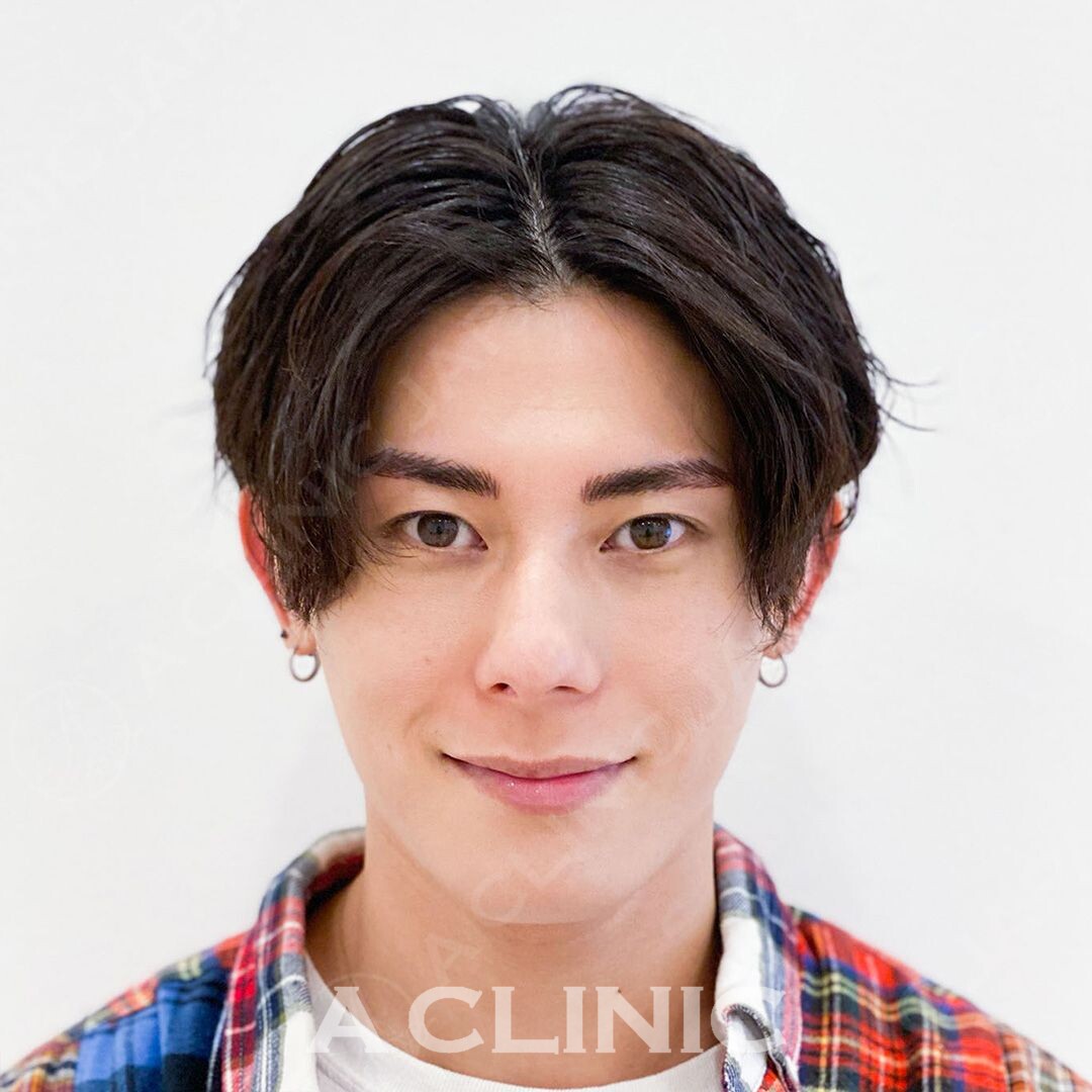 Aスレッドで頬のお肉もスッキリ引き上げリフトアップ！処置前と処置直後の症例です(30代男性) AFTER