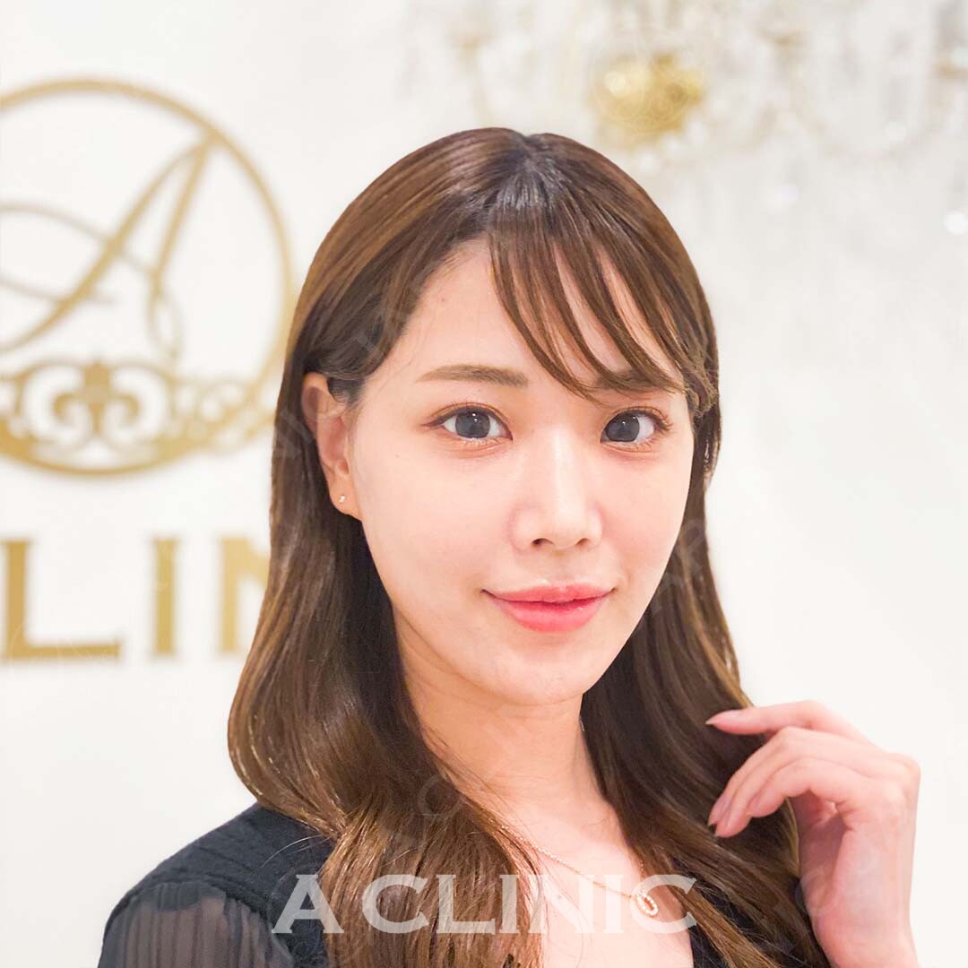 Aスレッドで綺麗な輪郭に！即日小顔をゲット！処置前と処置直後の症例です(20代女性) AFTER