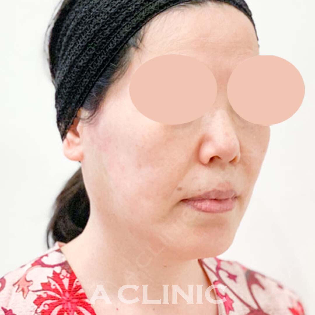 Aスレッドは少ない本数でしっかりたるみを引き上げます！処置前と処置直後の症例です(60代女性) AFTER