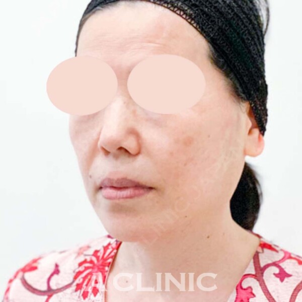 Aスレッドは口横のもたつきもたった15分で綺麗に引き上げます！処置前と処置直後の症例です(60代女性) AFTER