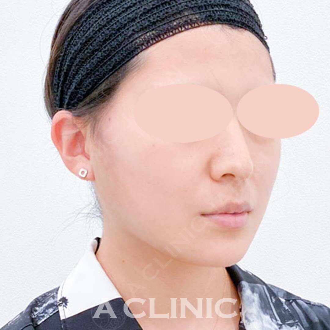 短時間で輪郭が劇的に変化して小顔になれちゃうんです！Aスレッドの処置前と処置直後の症例です(20代女性) AFTER