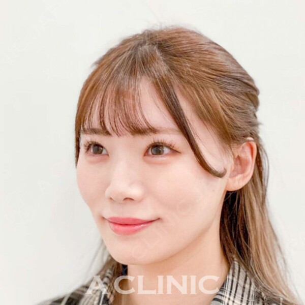 Aスレッドで直後からスッキリ小顔に！処置前と処置直後の症例です(20代女性) AFTER