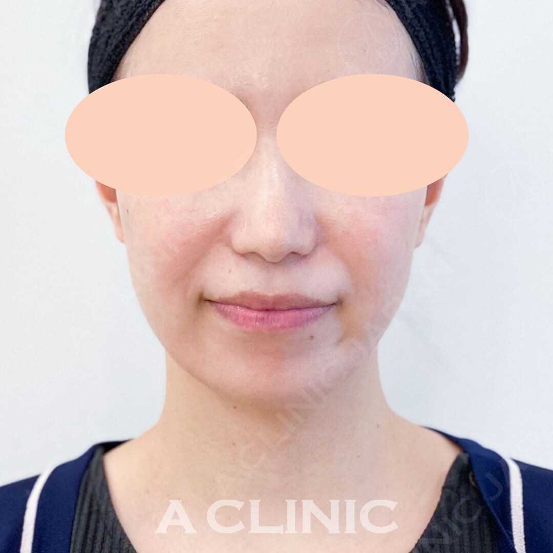 Aスレッドはたったの15分で理想の小顔に大変身！処置前と処置直後の症例です(30代女性) BEFORE