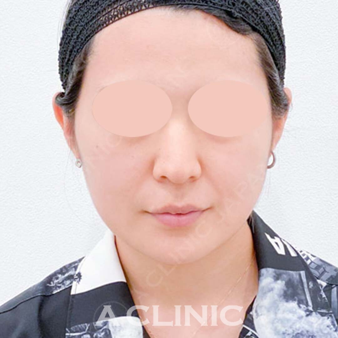 将来のたるみ予防に効果的です！Aスレッドの処置前と処置直後の症例です(20代女性) BEFORE