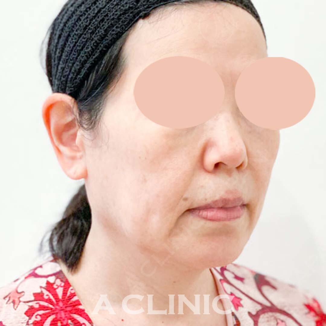 Aスレッドは少ない本数でしっかりたるみを引き上げます！処置前と処置直後の症例です(60代女性) BEFORE