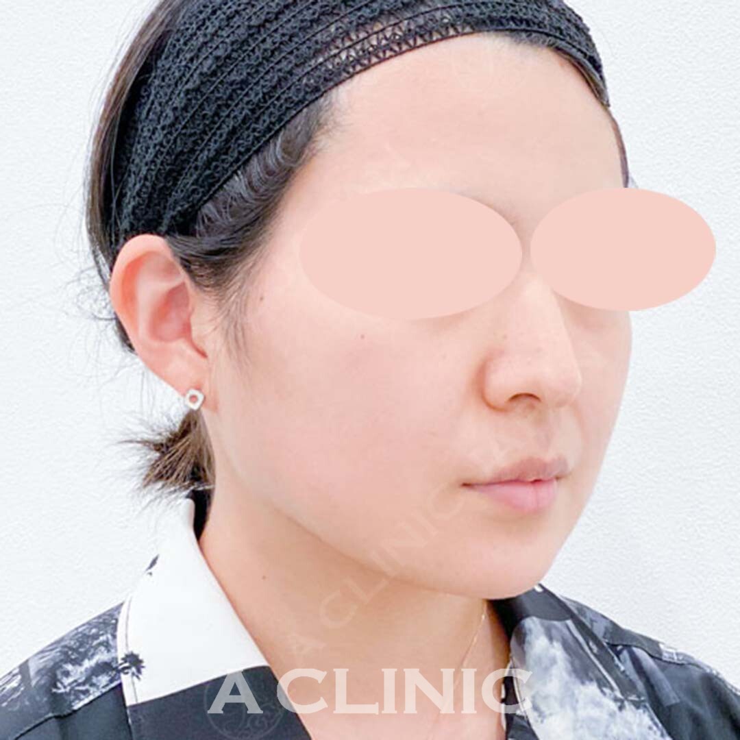 短時間で輪郭が劇的に変化して小顔になれちゃうんです！Aスレッドの処置前と処置直後の症例です(20代女性) BEFORE