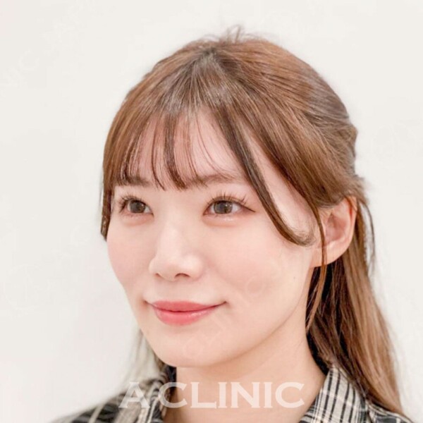 Aスレッドで直後からスッキリ小顔に！処置前と処置直後の症例です(20代女性) BEFORE