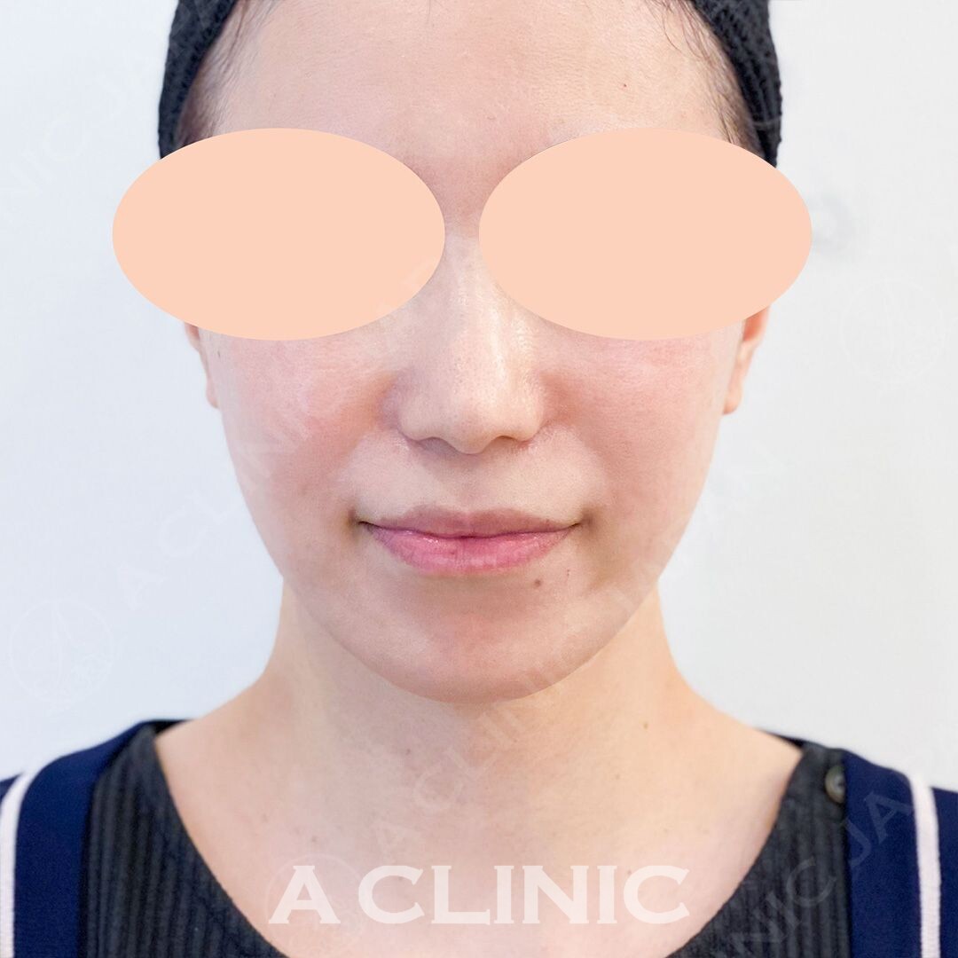 Aスレッドはたったの15分で理想の小顔に大変身！処置前と処置直後の症例です(30代女性) AFTER