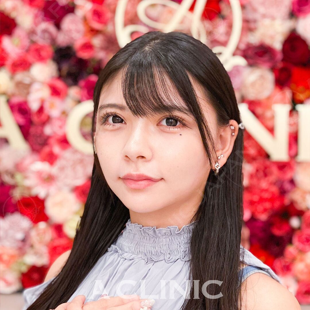 腫れやお痛みを最小限に抑えた小顔術！Aスレッドの処置前と処置直後の症例です(20代女性) AFTER