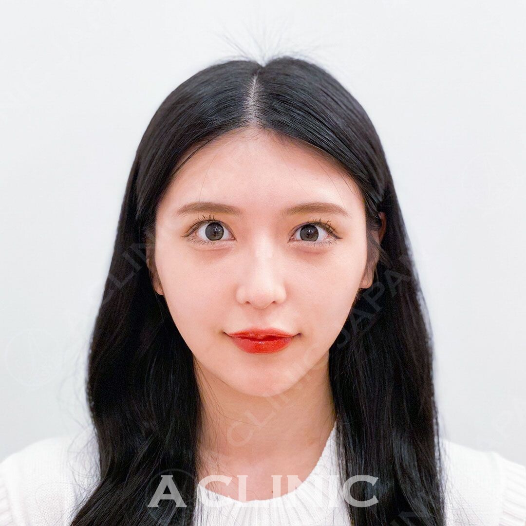 たった15分で綺麗なフェイスラインを手に入れられます！Aスレッドの処置前と処置直後の症例です(20代女性) AFTER