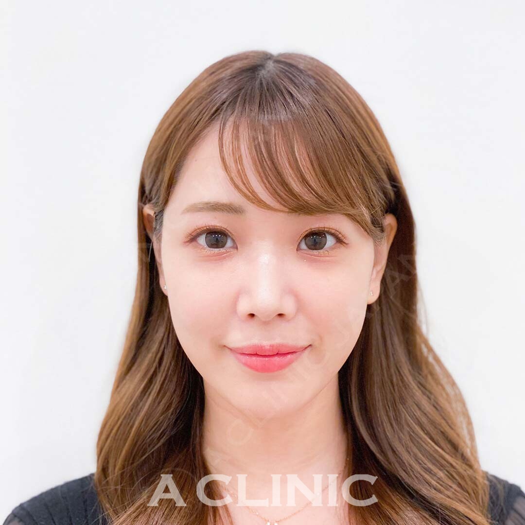 Aスレッドで当日から理想の小顔に！処置前と処置直後の症例です(20代女性) BEFORE