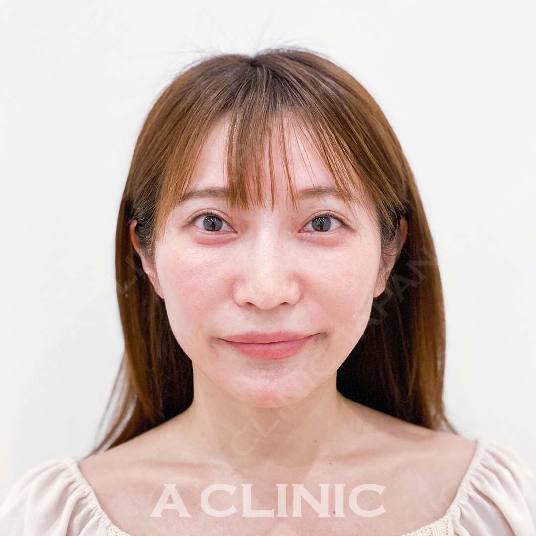 Aスレッドでよりフェイスラインが引き上がりより綺麗な輪郭に！処置前と処置直後の症例です(30代女性) BEFORE