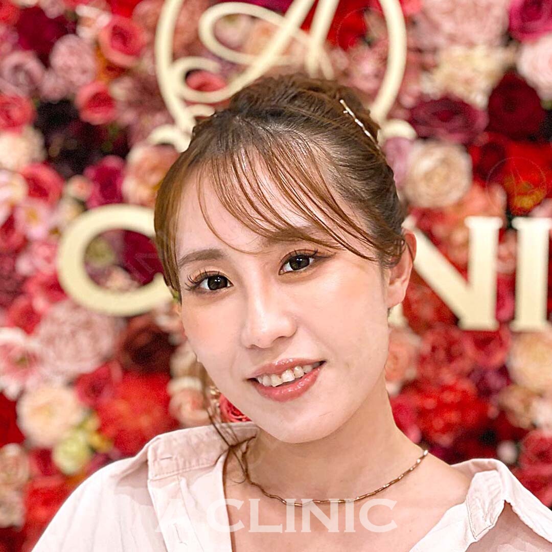 Aスレッドならダウンタイムなしで綺麗なフェイスラインに！施術前と施術直後の症例です(30代女性) BEFORE