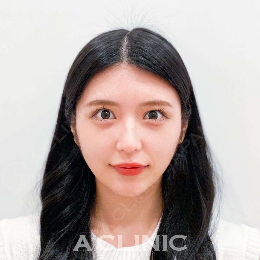 たった15分で綺麗なフェイスラインを手に入れられます！Aスレッドの処置前と処置直後の症例です(20代女性) BEFORE