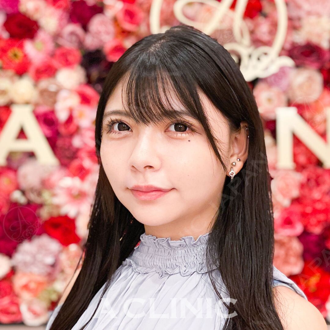 腫れやお痛みを最小限に抑えた小顔術！Aスレッドの処置前と処置直後の症例です(20代女性) BEFORE