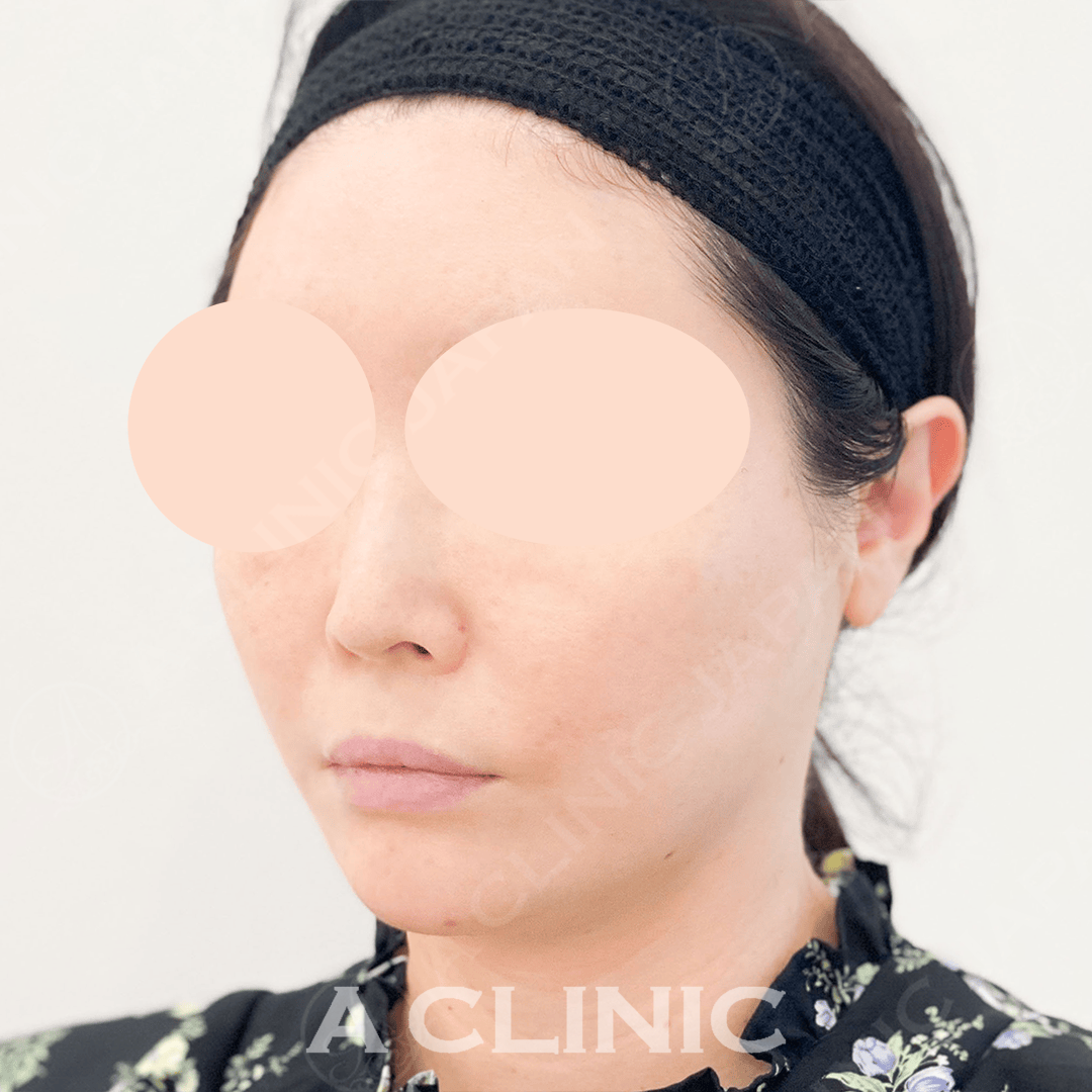 お肌のハリと艶感も実感できAスレッドで若々しいお顔に！処置前と処置直後の症例です(40代女性) AFTER