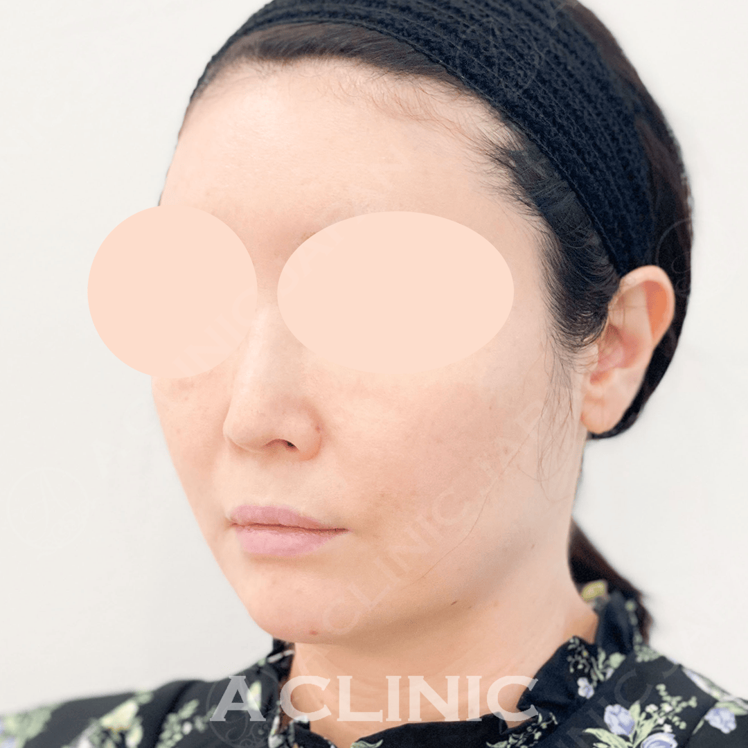 お肌のハリと艶感も実感できAスレッドで若々しいお顔に！処置前と処置直後の症例です(40代女性) BEFORE