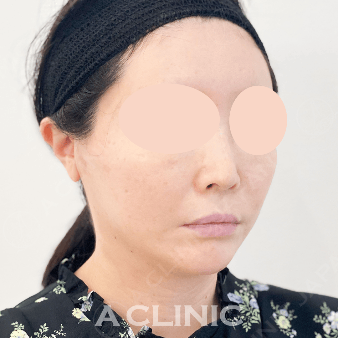 フェイスラインのもたつきがシュッと綺麗なVラインに！Aスレッド処置前と処置直後の症例です(40代女性) AFTER