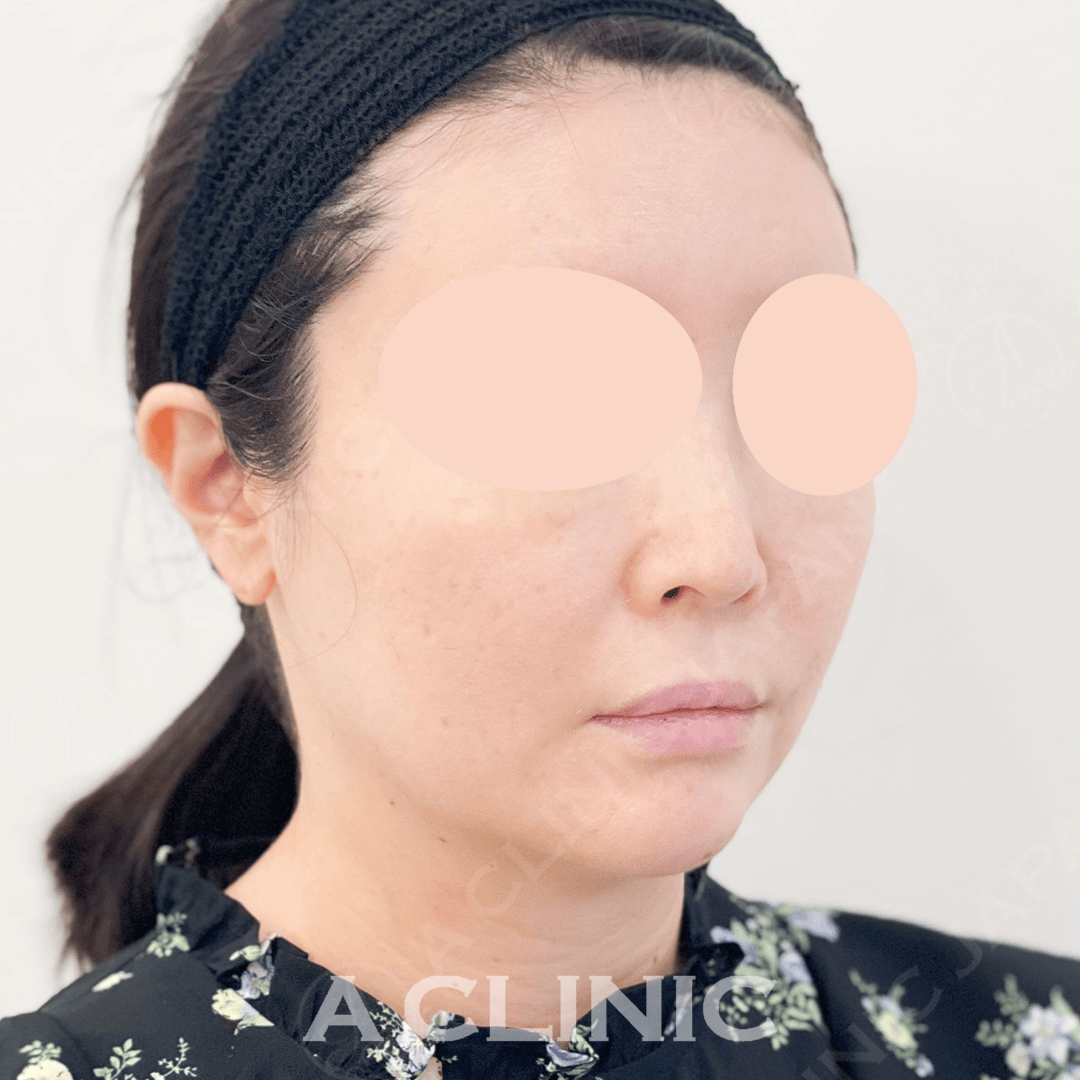 フェイスラインのもたつきがシュッと綺麗なVラインに！Aスレッド処置前と処置直後の症例です(40代女性) BEFORE