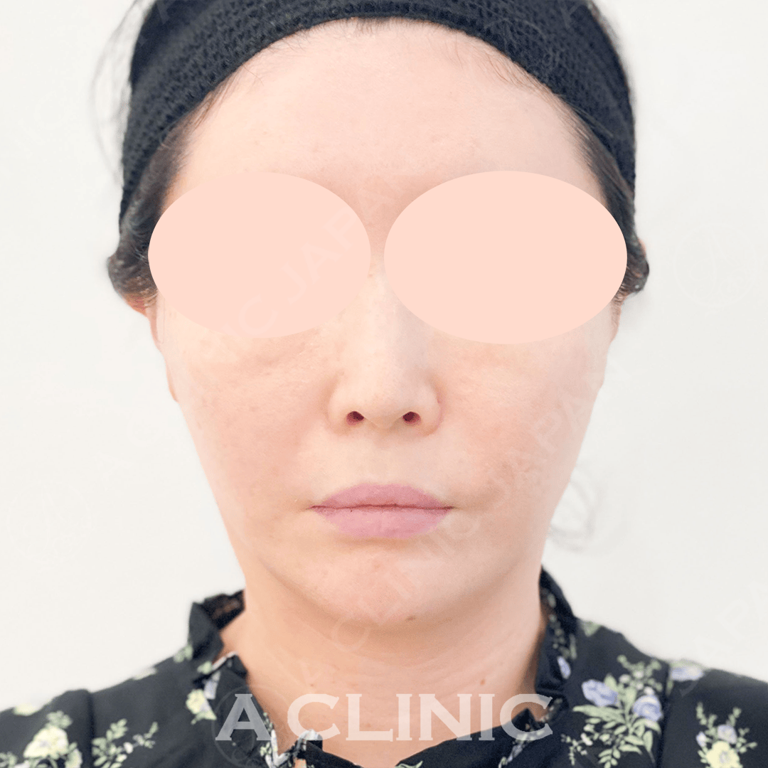 たったの１５分でお顔が一回り小さく！Aスレッド処置前と直後の症例です(40代女性) AFTER