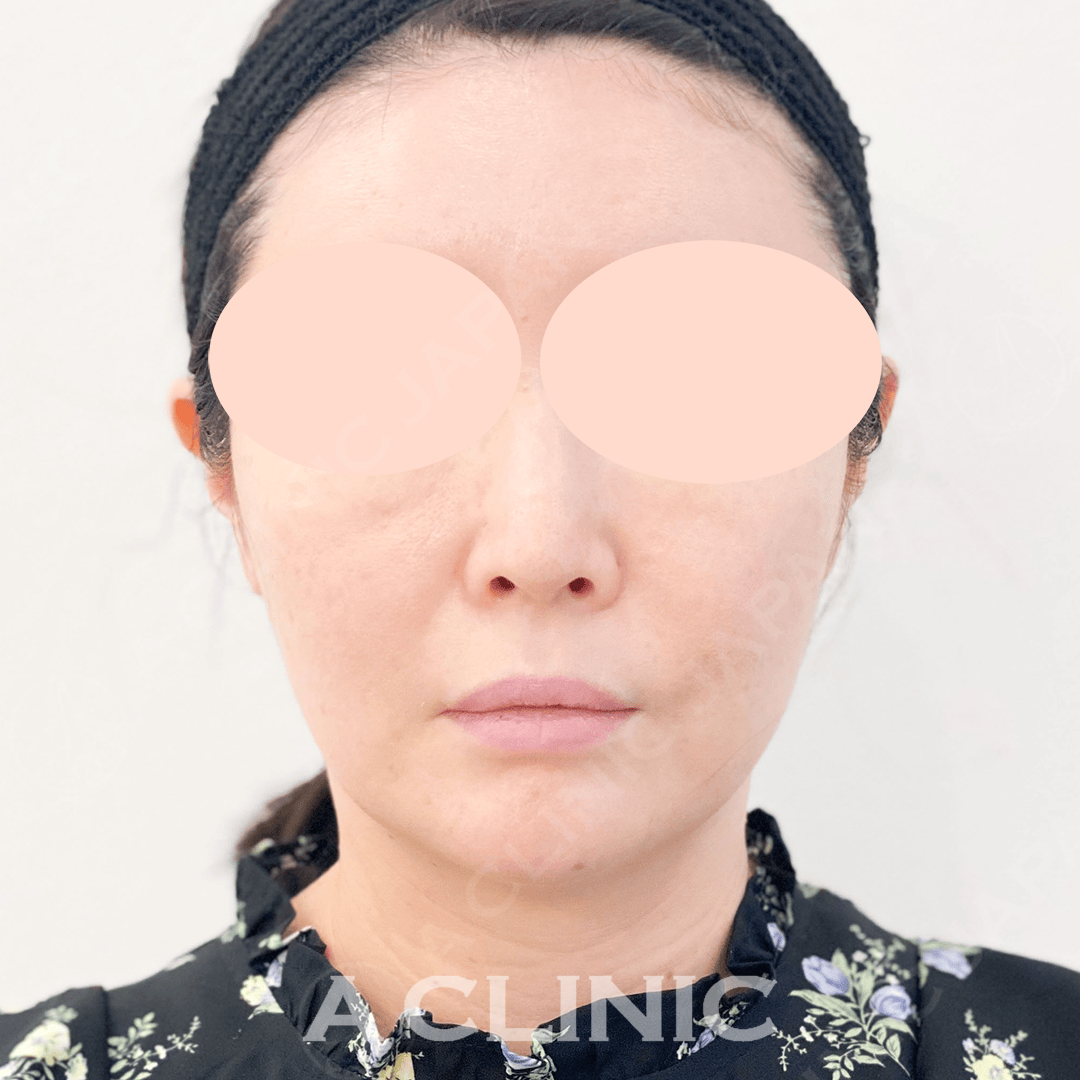 たったの１５分でお顔が一回り小さく！Aスレッド処置前と直後の症例です(40代女性) BEFORE