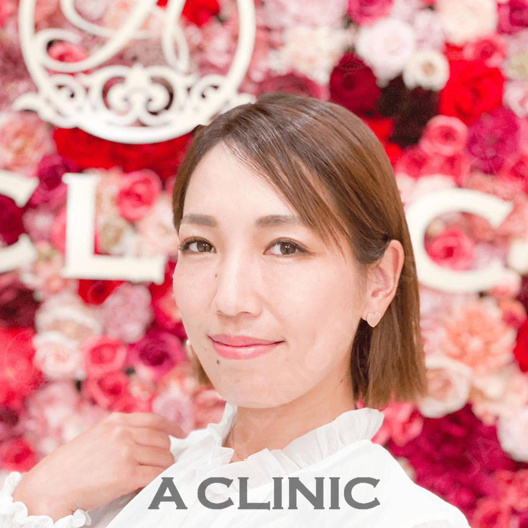 Aスレッドには美肌効果もあります！処置前と処置直後の症例です(30代女性) BEFORE