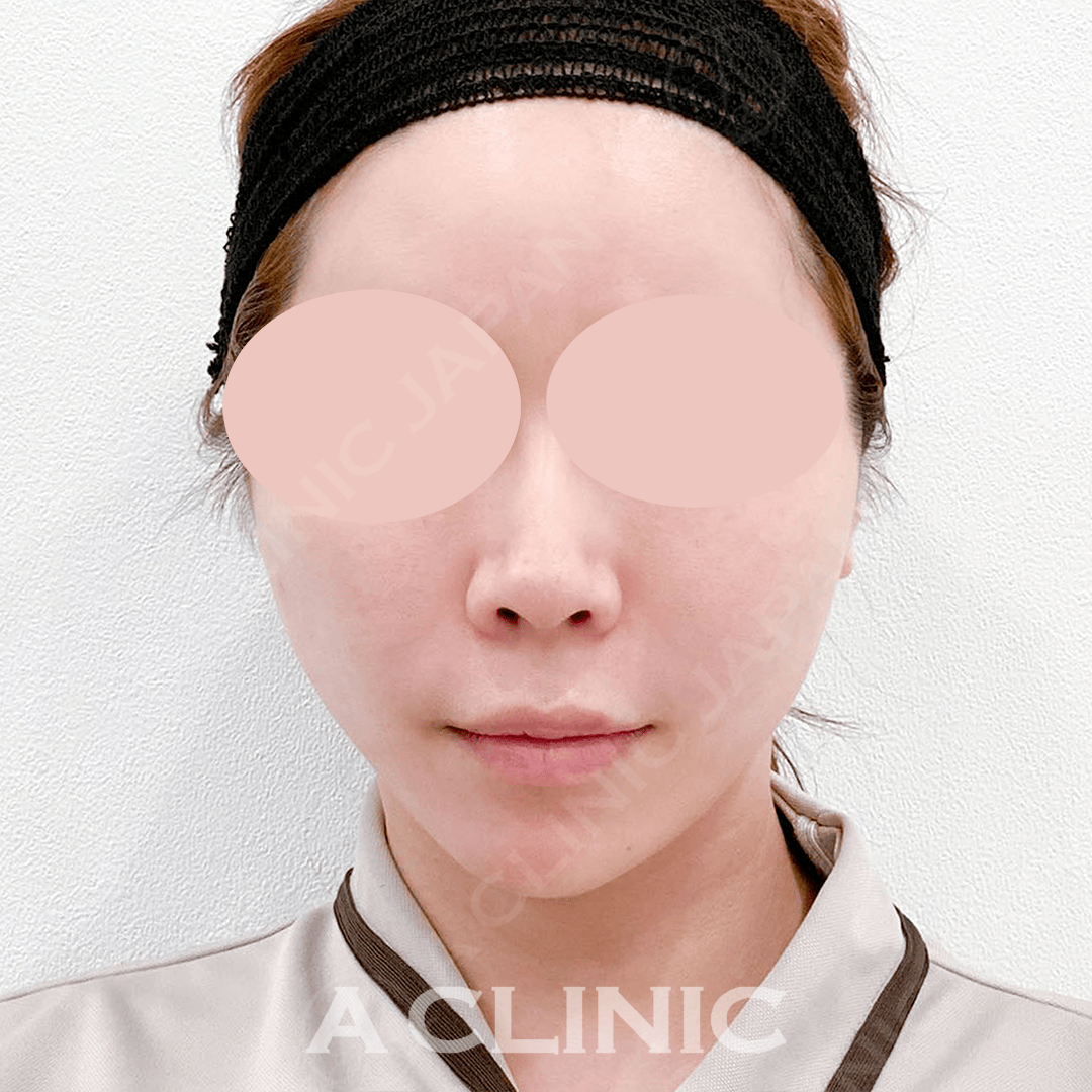 Aスレッド＋エッグフェイスでより理想のフェイスラインに！処置前と処置直後の症例です(30代女性) AFTER