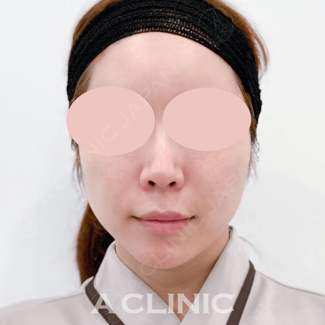 Aスレッド＋エッグフェイスでより理想のフェイスラインに！処置前と処置直後の症例です(30代女性) BEFORE