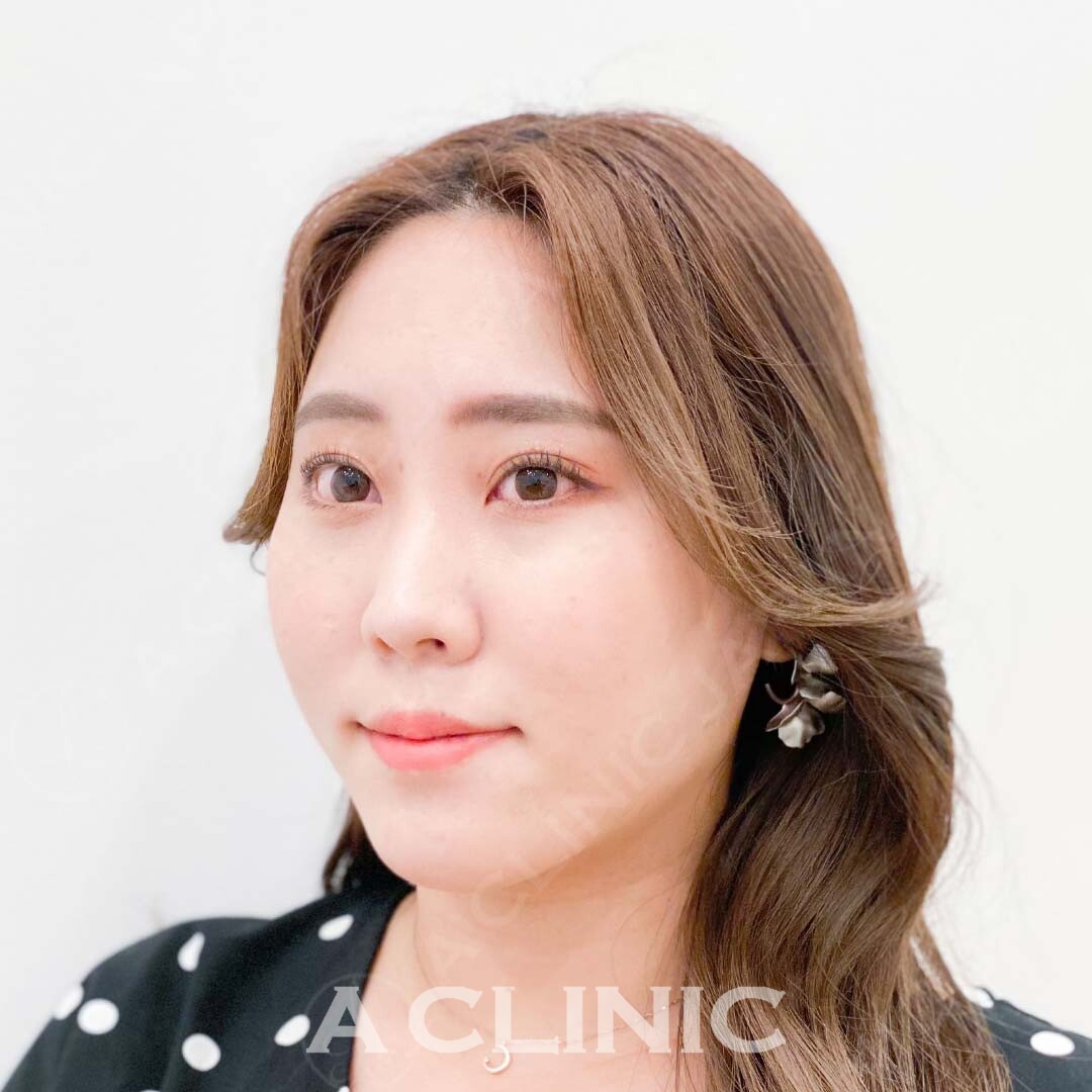 エラ周りの脂肪もたつきを解消！Aスレッド処置直前と処置直後の症例です(20代女性) AFTER