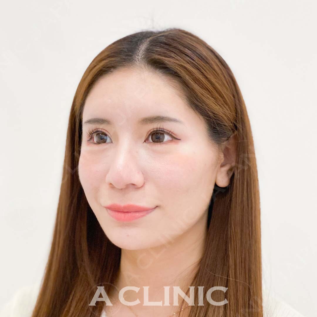 Aスレッドでその日から顔痩せ実感！こちら処置前と処置直後の症例です(20代女性) AFTER