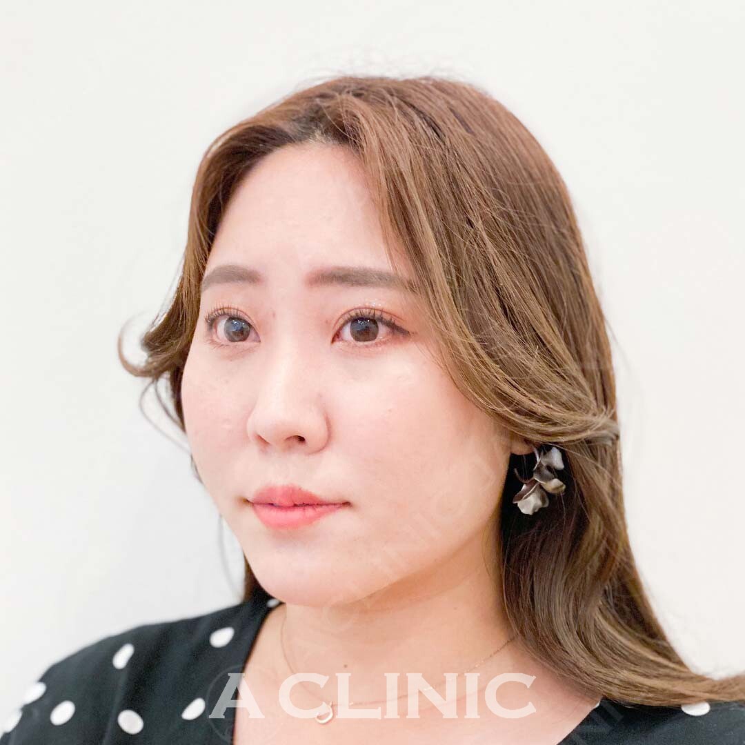 エラ周りの脂肪もたつきを解消！Aスレッド処置直前と処置直後の症例です(20代女性) BEFORE