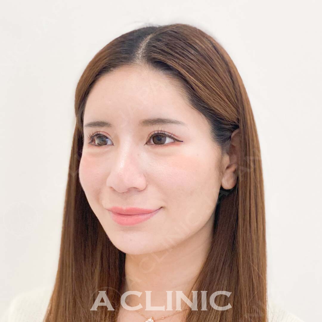 Aスレッドでその日から顔痩せ実感！こちら処置前と処置直後の症例です(20代女性) BEFORE