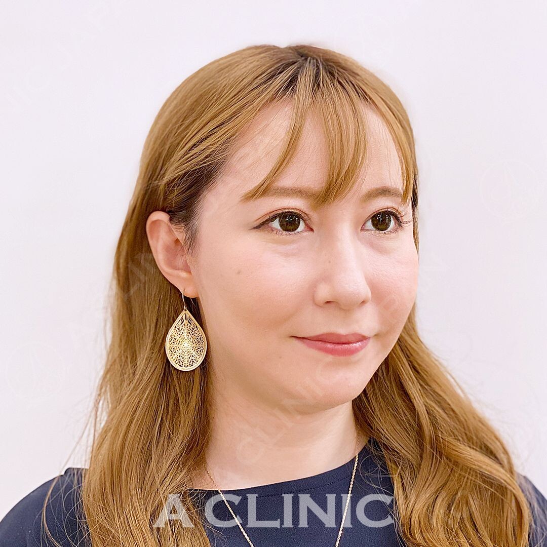 フェイスラインが生まれ変わる！処置時間15分のAスレッドの処置前と処置直後の症例です(30代女性) AFTER