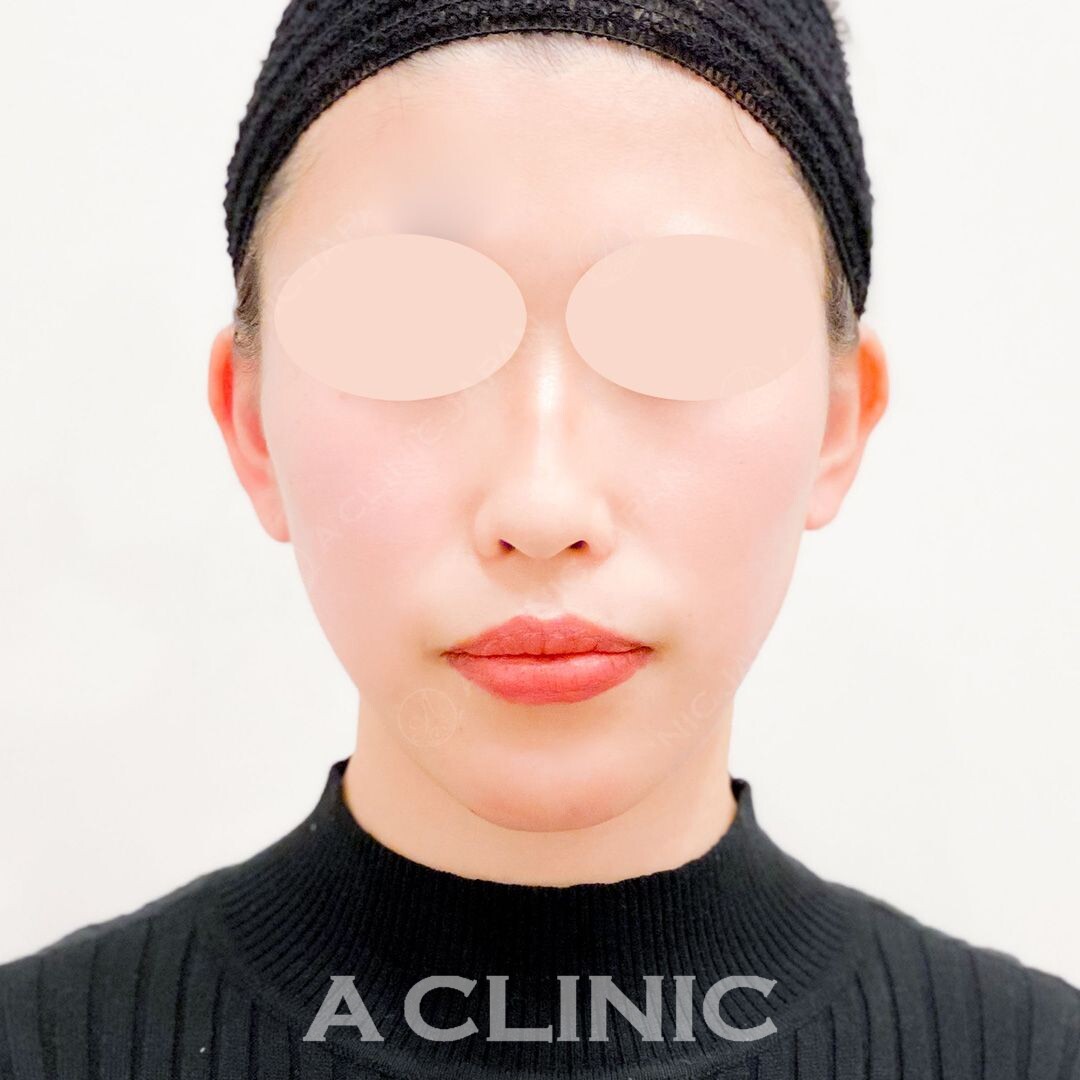 その日から口元のたるみを引き上げ小顔に！こちらAスレッド処置前と処置直後の症例です(20代女性) AFTER