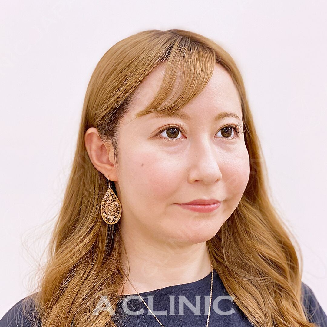 フェイスラインが生まれ変わる！処置時間15分のAスレッドの処置前と処置直後の症例です(30代女性) BEFORE