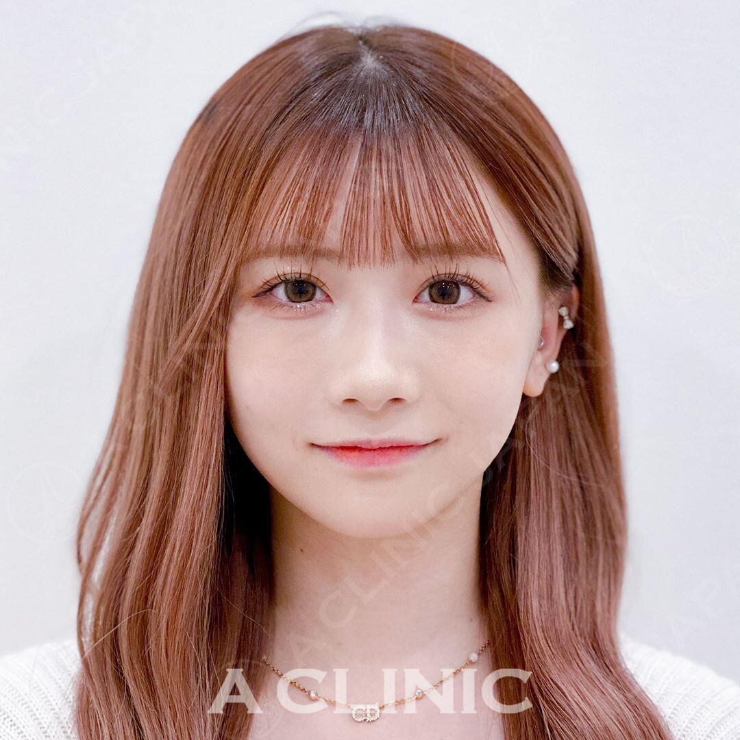 ぷっくりフェイスラインをその日のうちにシャープに！Aスレッドの処置前と直後の症例です(20代女性) AFTER