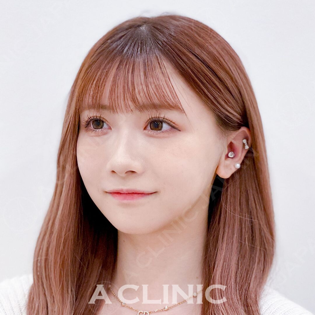 Aスレッドでもたつき解消し小顔に変身！処置前と処置直後の症例写真です(20代女性) AFTER