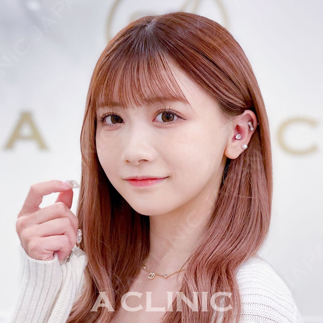 加工アプリ級の小顔に大変身！小顔Aスレッド処置直後の症例です(20代女性) AFTER