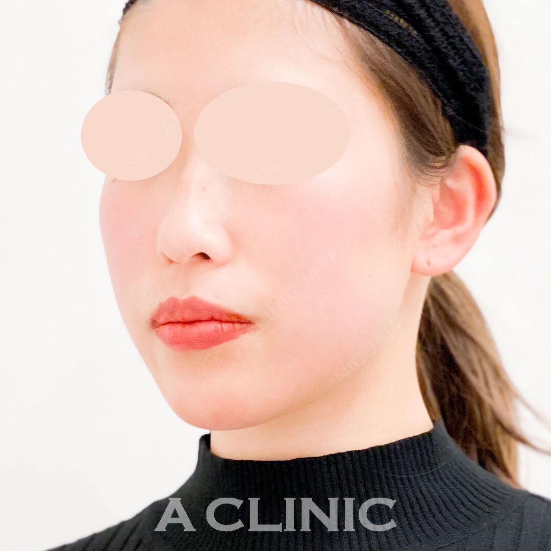 Aスレッドで輪郭がすっきりピタッと小顔に！こちら処置前と処置直後の症例です(20代女性) BEFORE
