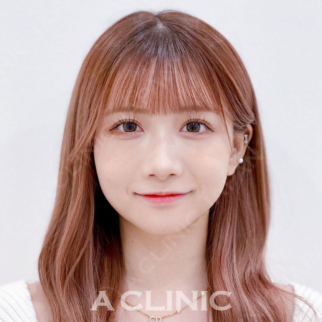 ぷっくりフェイスラインをその日のうちにシャープに！Aスレッドの処置前と直後の症例です(20代女性) BEFORE