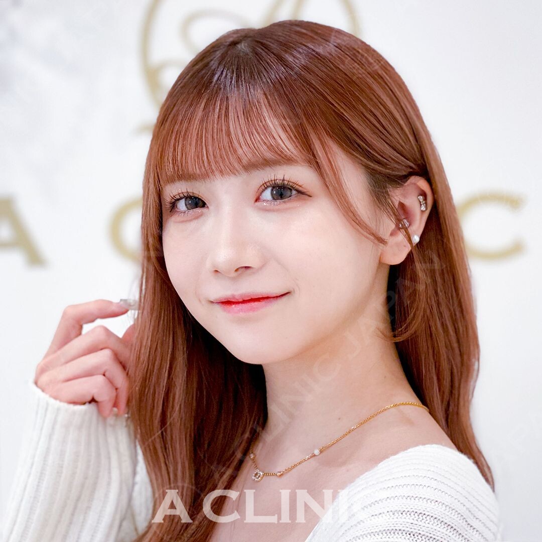 加工アプリ級の小顔に大変身！小顔Aスレッド処置直後の症例です(20代女性) BEFORE