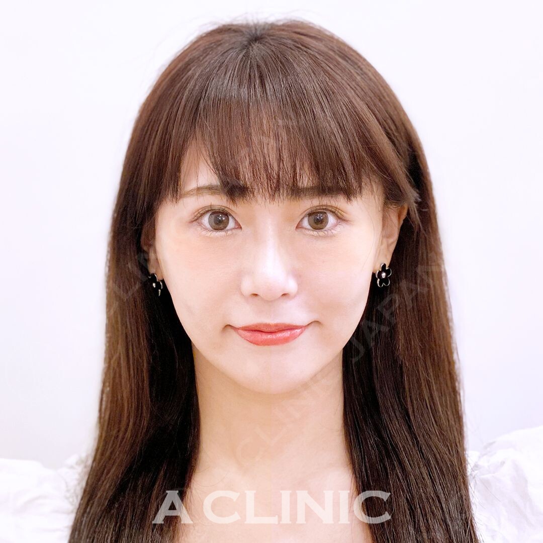 たるみがなくなるとスッキリ若返ります！Aスレッド処置前と処置直後の症例です(30代女性) AFTER