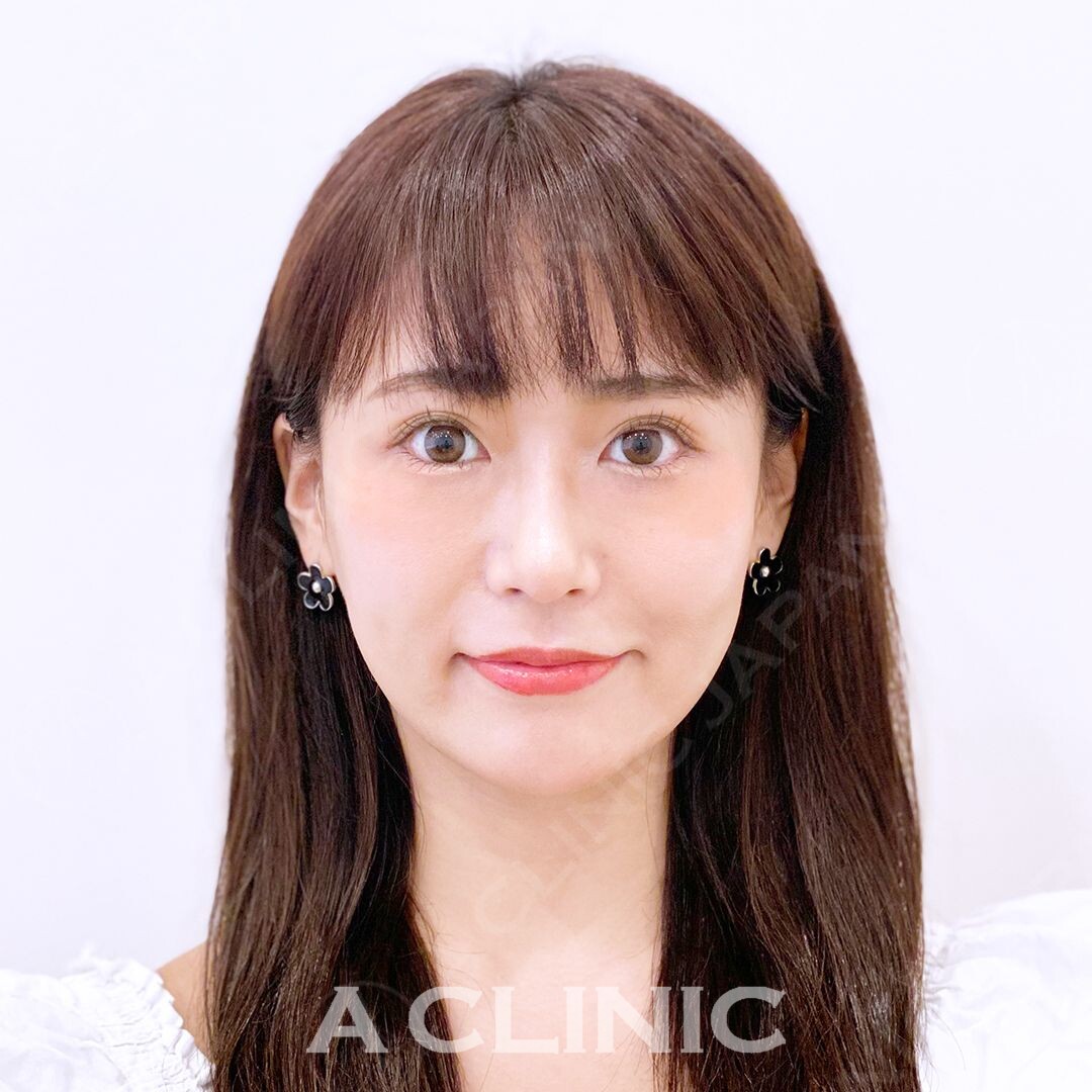 たるみがなくなるとスッキリ若返ります！Aスレッド処置前と処置直後の症例です(30代女性) BEFORE