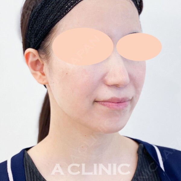 気になるほうれい線もしっかりリフトアップ！Aスレッドの処置前と処置直後の症例です(30代女性) BEFORE