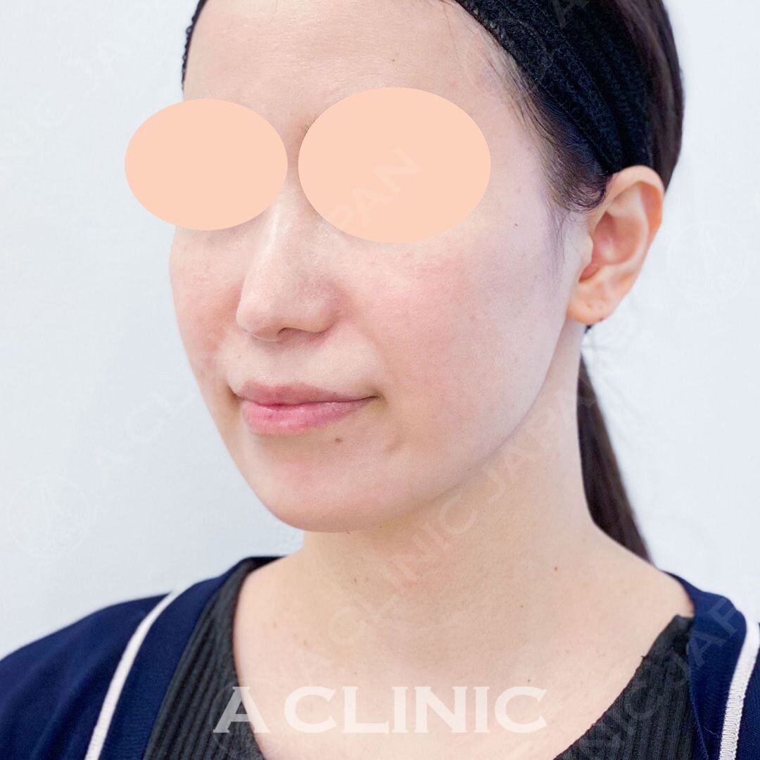 口横のもたつきもその日のうちに解消！Aスレッドの処置前と処置直後の症例です(30代女性) BEFORE